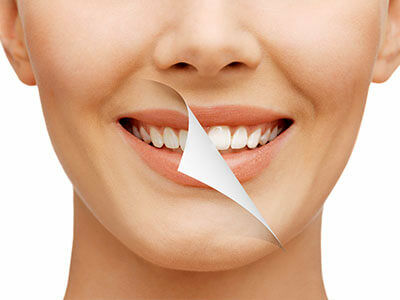 Teeth Whitening