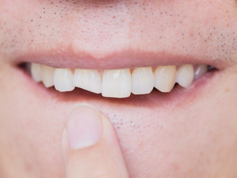 Got A Cracked Tooth? See A Dentist Right Away!