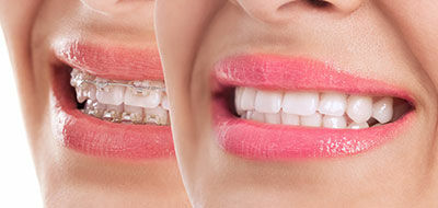 Braces