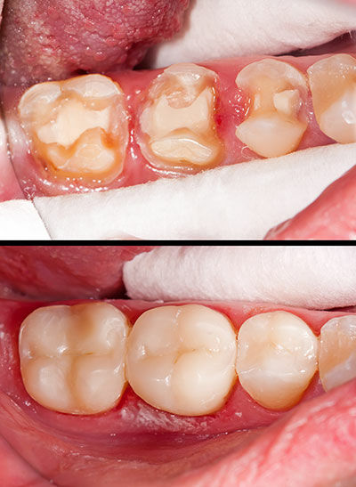 Composite or “Tooth Colored” Fillings
