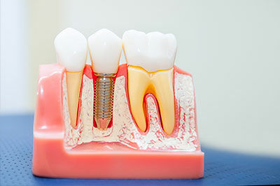 Dental Implants