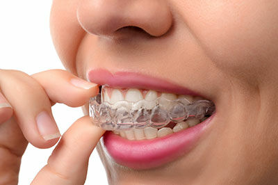 Invisalign