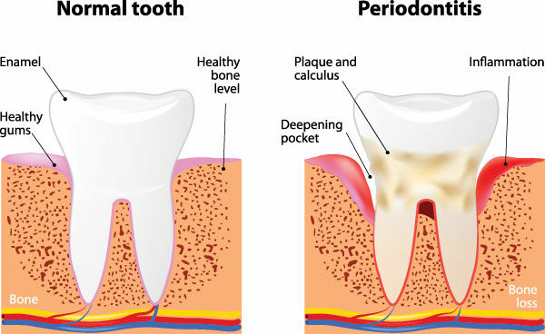 Non-Surgical Periodontal Treatment