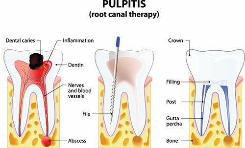 Root Canal Therapy