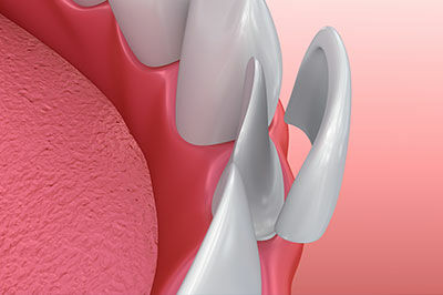 Veneers